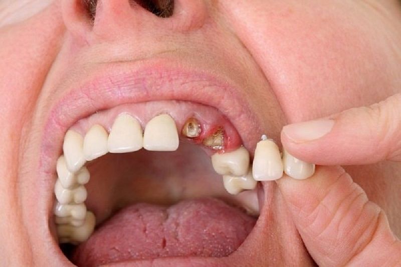 Giải mã giấc mơ rụng răng tại Sin88: Dấu hiệu tâm linh và cơ hội “bắt số chuẩn”